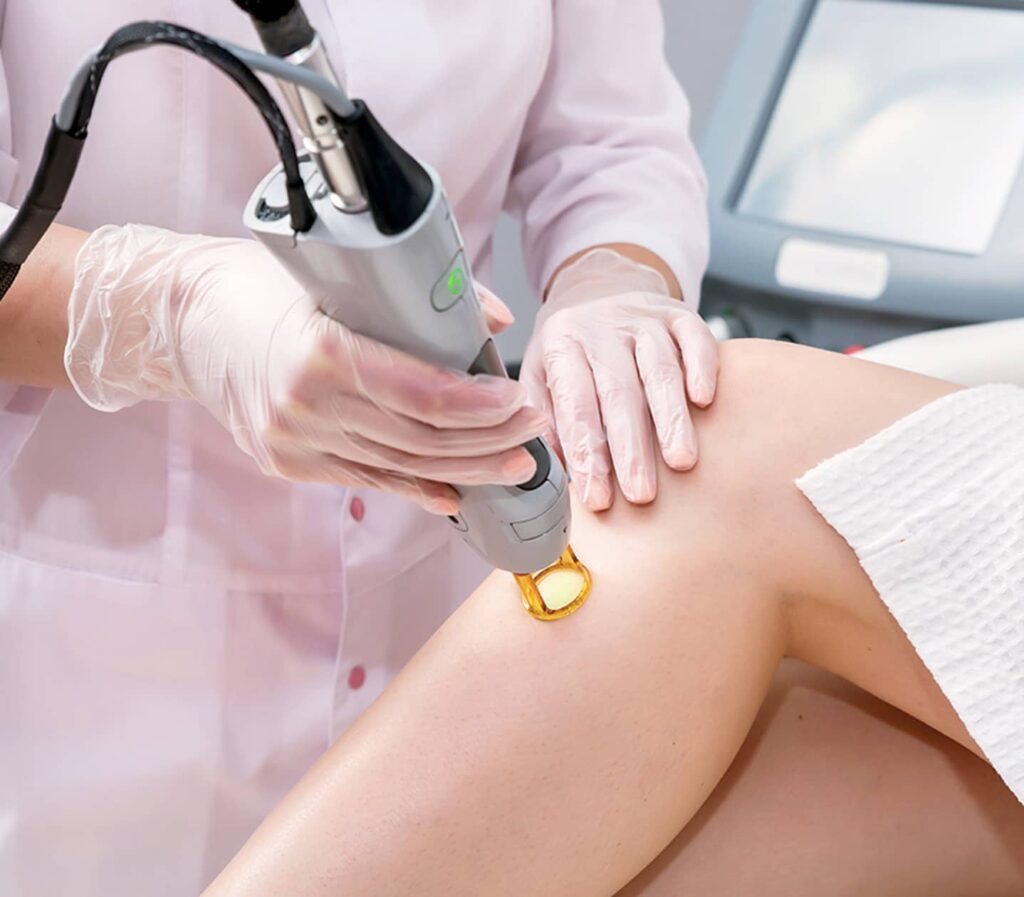 Epilation laser d'une zone sur la jambe d'une cliente