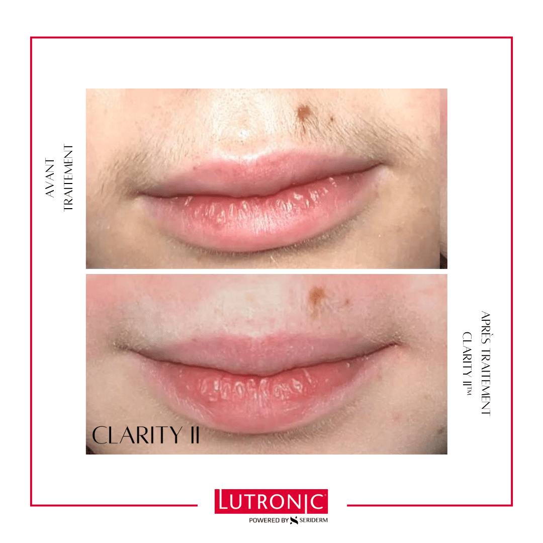 Épilation laser femme Centre du champ de mars