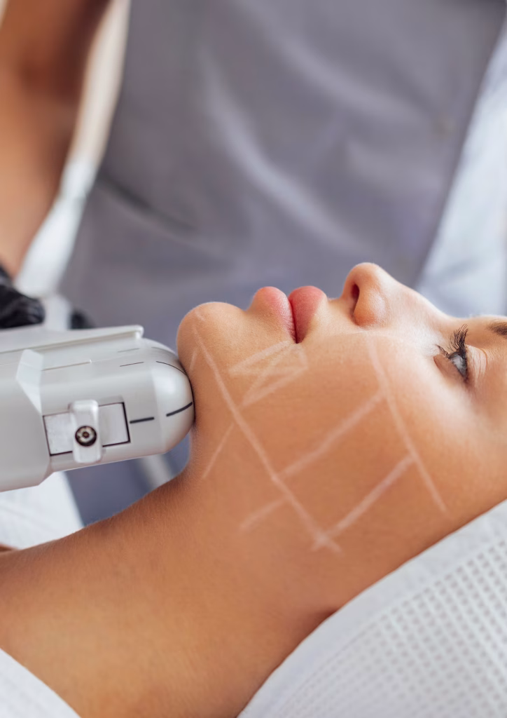 Soins HIFU visage ciblant le menton chez une patiente en position allongée