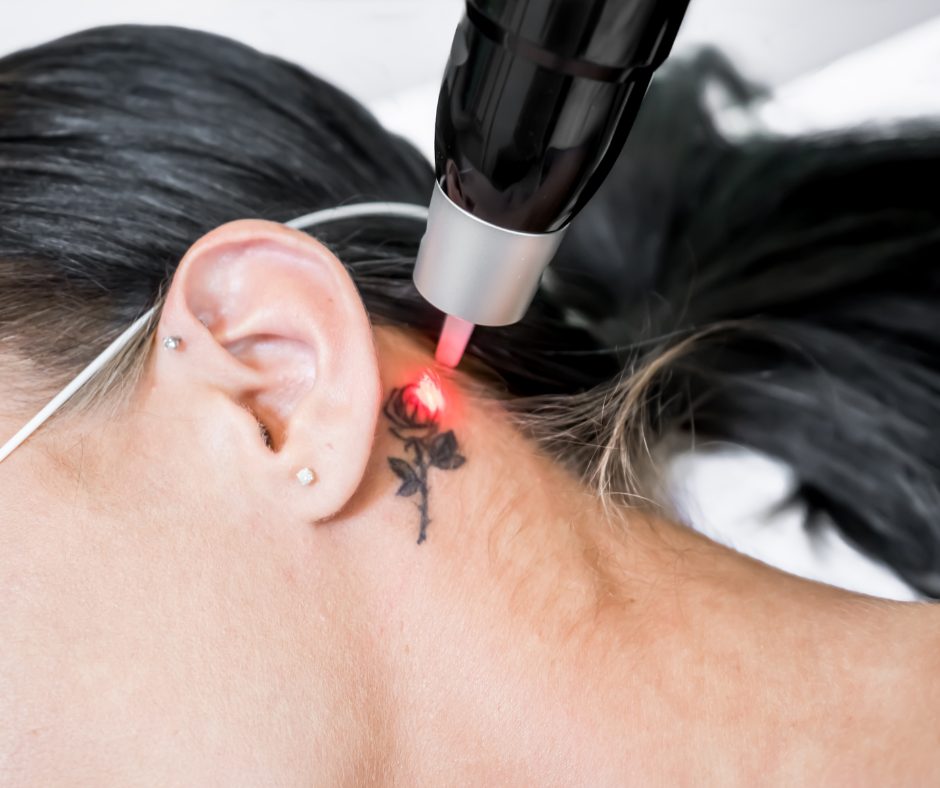 Salon de détatouage réalisant un detatouage laser d’un motif rose placé derrière l’oreille Paris