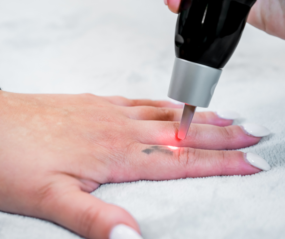 Detatouage laser d’un tatouage sur le doigt avec lumière ciblée, en salon de détatouage Paris