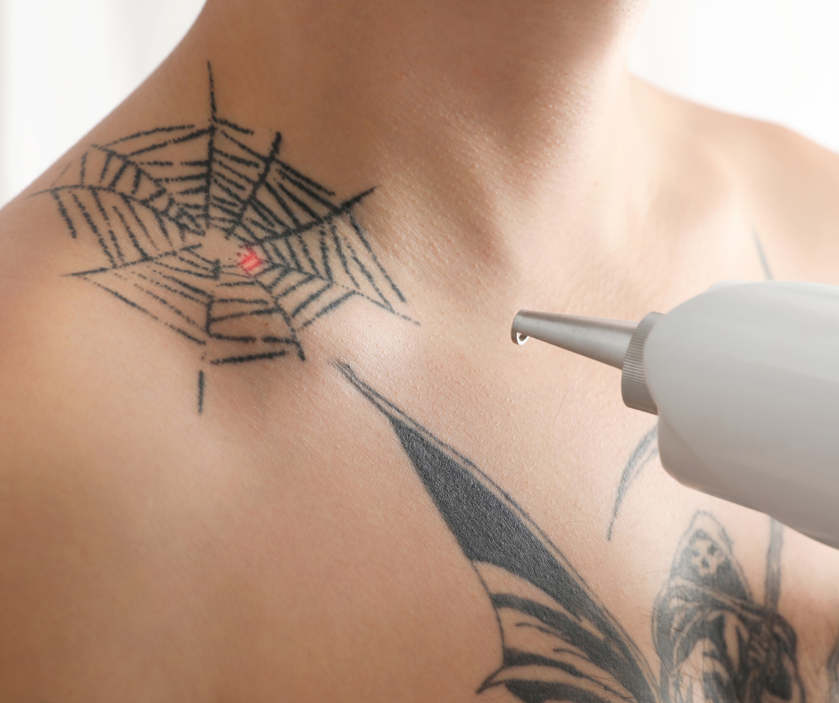 Salon de détatouage réalisant un detatouage laser sur une épaule avec tatouage toile d’araignée Paris