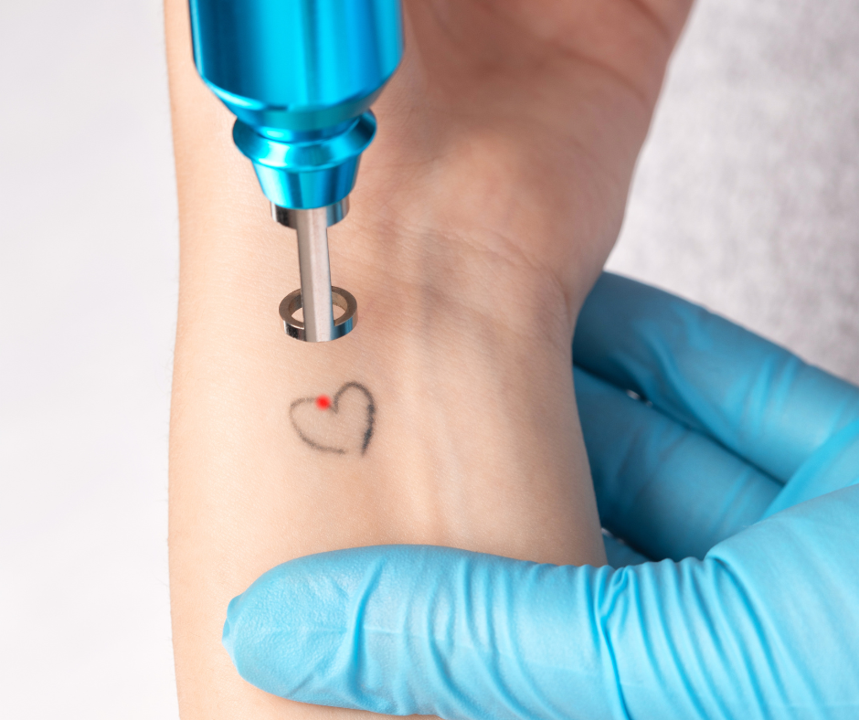 Detatouage laser d’un petit tatouage en forme de cœur sur le poignet, réalisé dans un salon de détatouage professionnel Paris.