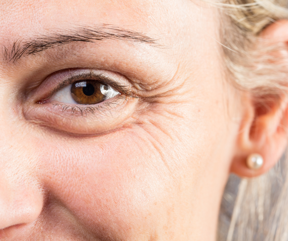 Rides du contour de l’œil visibles avant traitement par injection de Botox pour les pattes d’oie