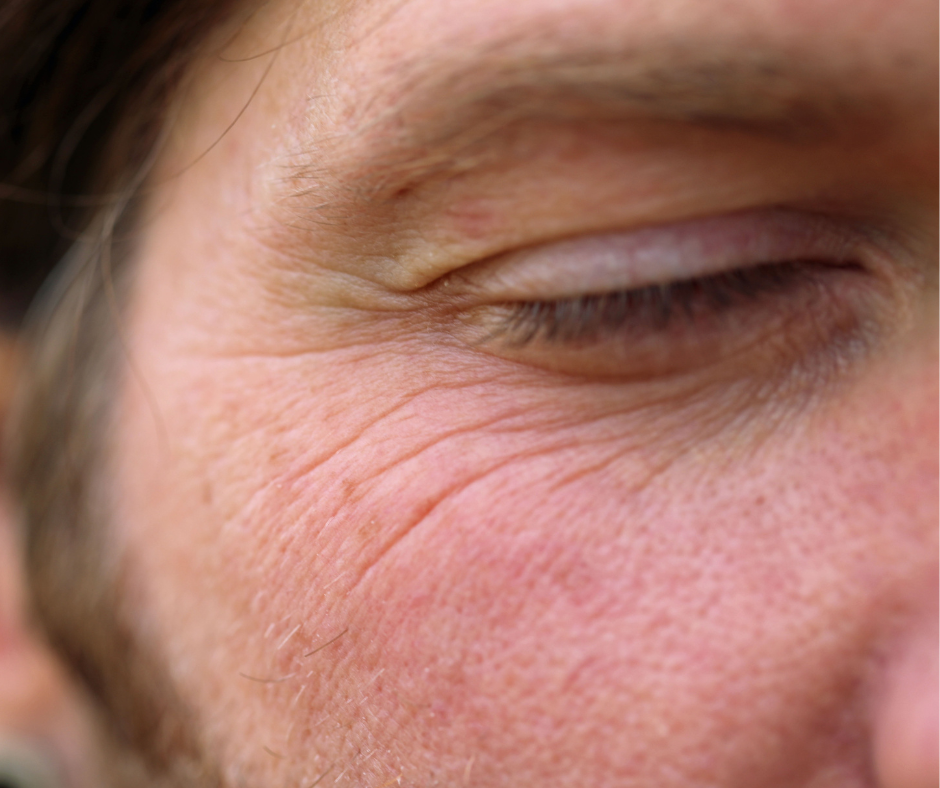 Pattes d’oie marquées sur le visage d’un homme avant injection de Botox