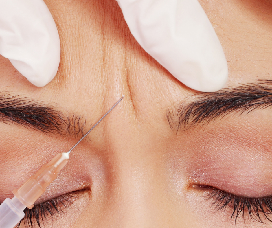 Injection de Botox pour la ride du lion entre les sourcils afin de détendre le front