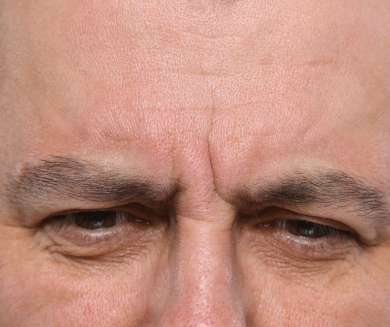Injection de Botox pour atténuer la ride du lion entre les sourcils