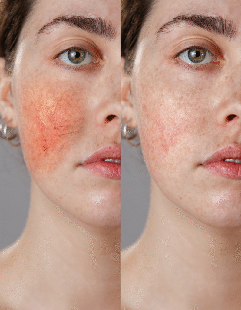 Comparaison avant et après traitement des rougeurs de la couperose sur le visage d'une femme