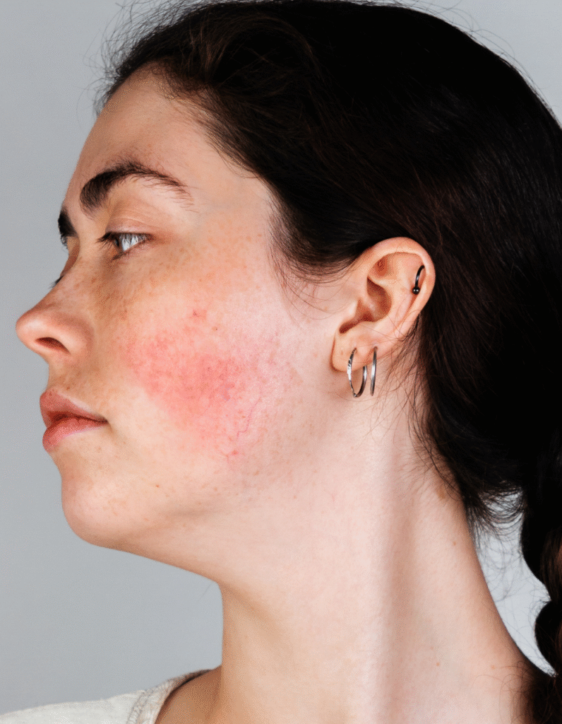 Femme avec des rougeurs diffuses et des vaisseaux visibles sur la joue, symptômes typiques de la couperose