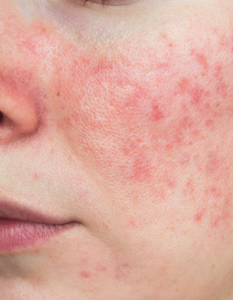 Gros plan d'une joue avec inflammation cutanée, rougeurs et petits vaisseaux dilatés associés à la couperose
