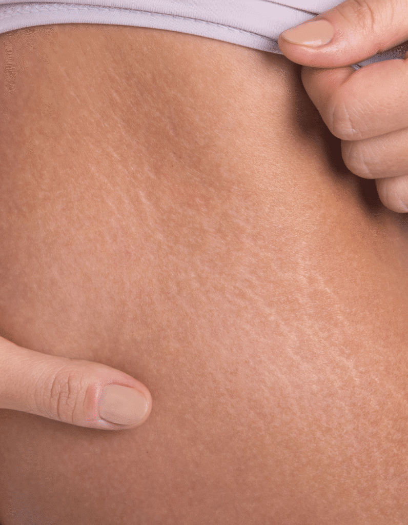 Grosse vergeture blanche visible sur la hanche d'une femme en sous-vêtement clair.