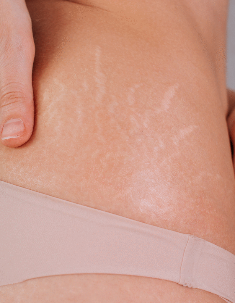 Vergetures blanches en forme d’étoile visibles sur la hanche d’une femme.