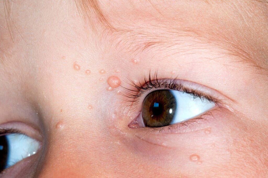 Petits boutons arrondis de molluscum contagiosum visibles sur la peau autour de l’œil d’un enfant