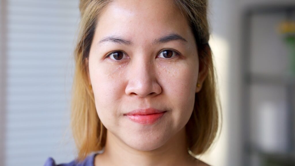 Portrait d’une femme présentant de petits grains de milium blancs autour des yeux et sur les joues