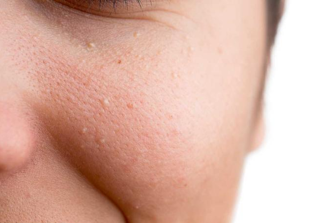 Gros plan d’une joue présentant des petits grains blancs appelés grains de milium