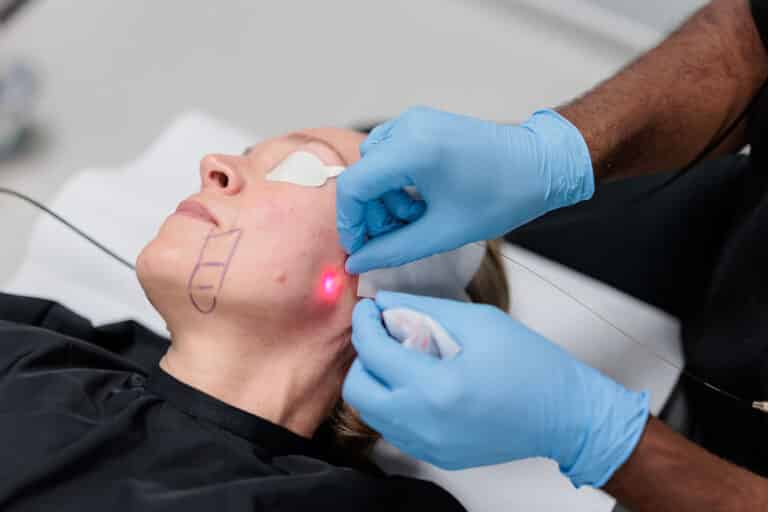 Traitement Endolift du visage par fibre laser pour agir sur le relâchement cutané