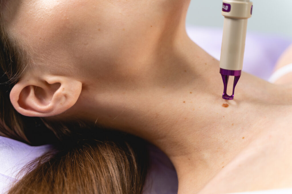Retrait d’un acrochordon au cou par un dermatologue – Centre du Champ de Mars Paris