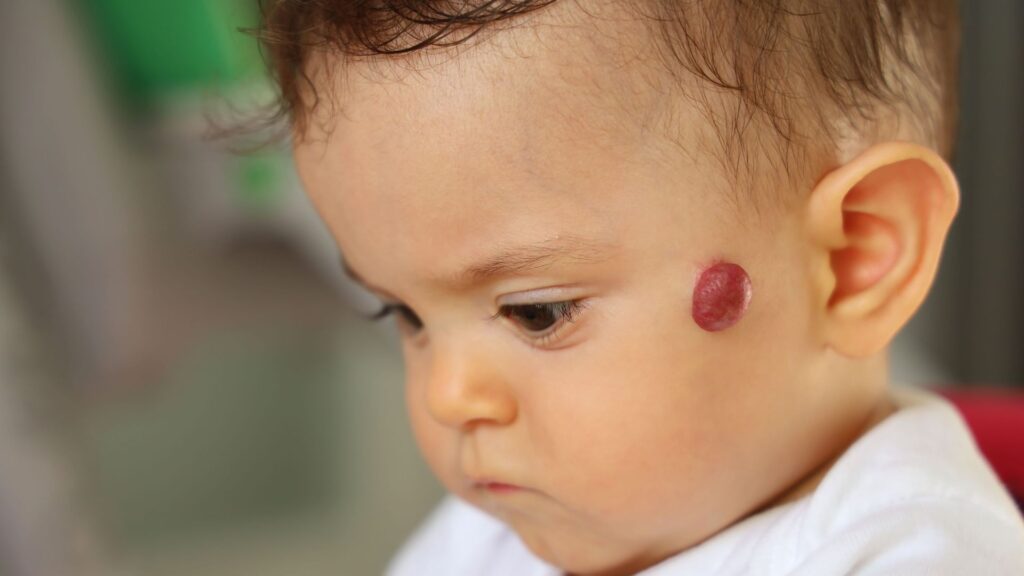 Nourrisson présentant un angiome sur la joue, consultation de dermatologie infantile à Paris