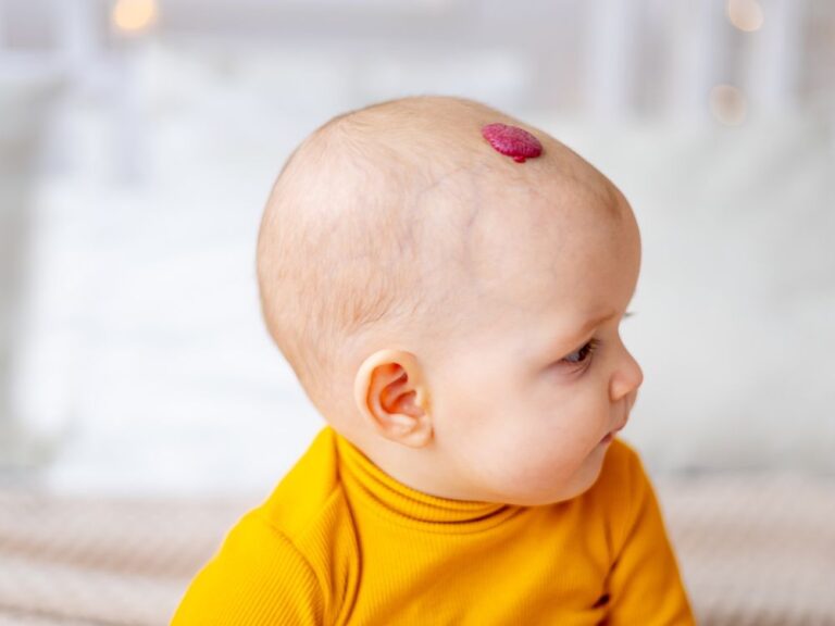 Photo d’un bébé avec un angiome tubéreux rouge sur le cuir chevelu, nécessitant un suivi et un traitement dermatologique spécialisé