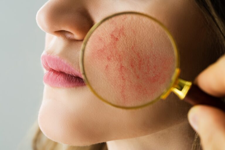 Gros plan d’une joue présentant une érythrose, observée à la loupe pour un diagnostic dermatologique