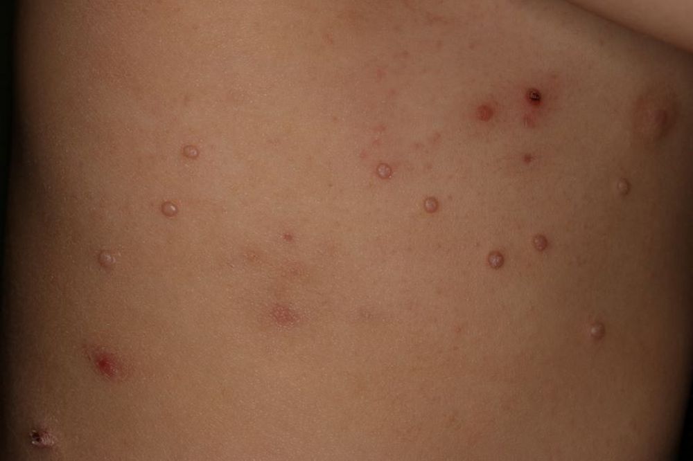 Multiples lésions arrondies de molluscum contagiosum visibles sur la peau du tronc
