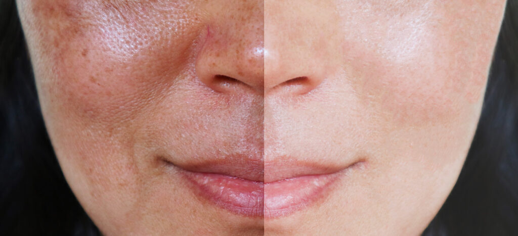 Comparaison du visage avant et après traitement du lentigo, avec atténuation des taches brunes et peau plus uniforme