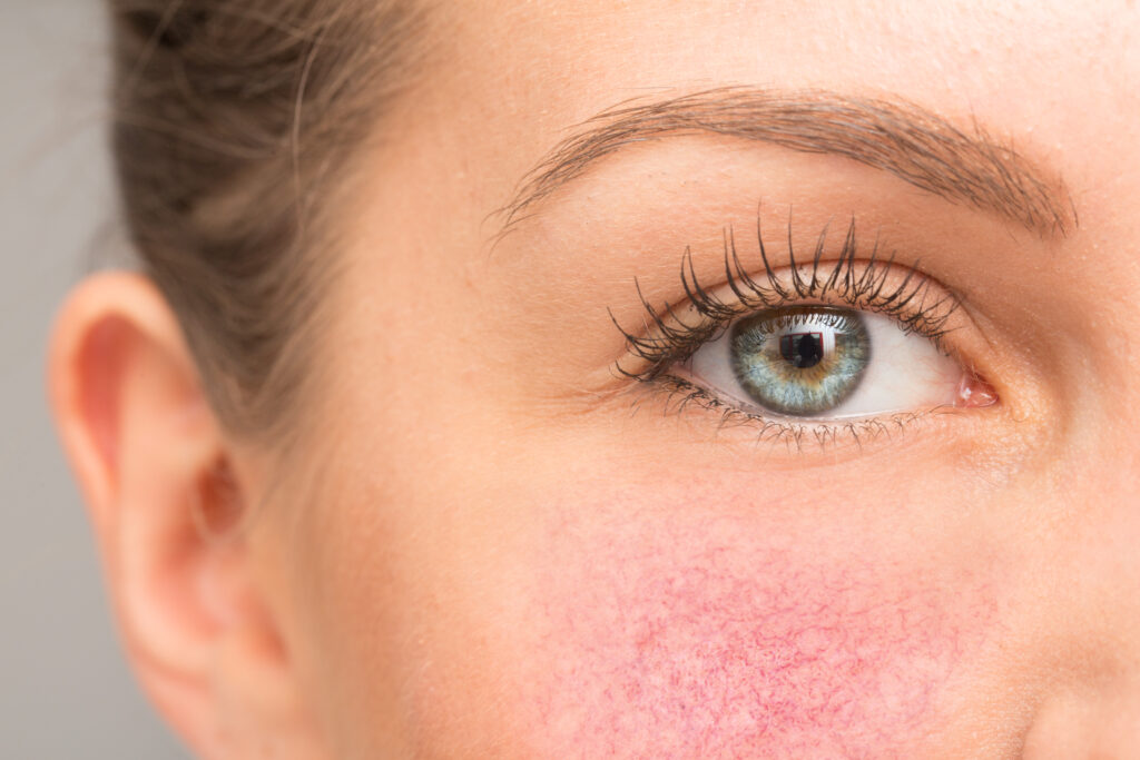 Gros plan sur la joue d’une femme présentant une érythrose, visible sous l’œil, nécessitant un traitement dermatologique au laser