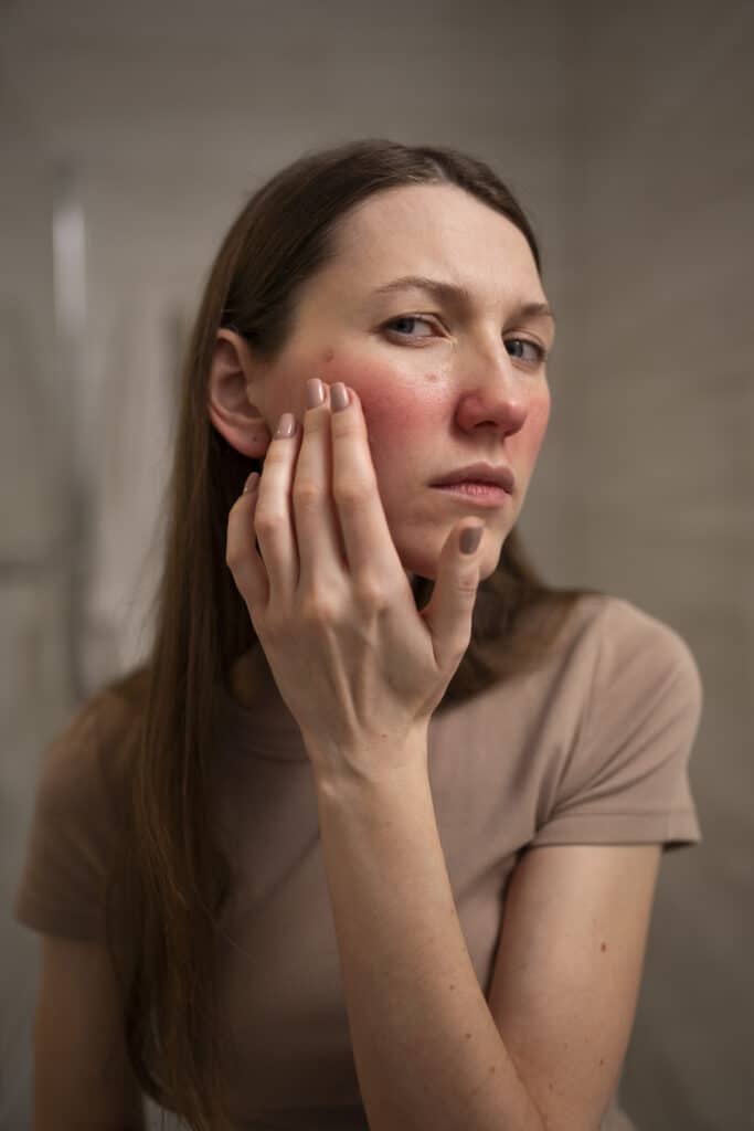 Femme devant un miroir qui constate la rosacee