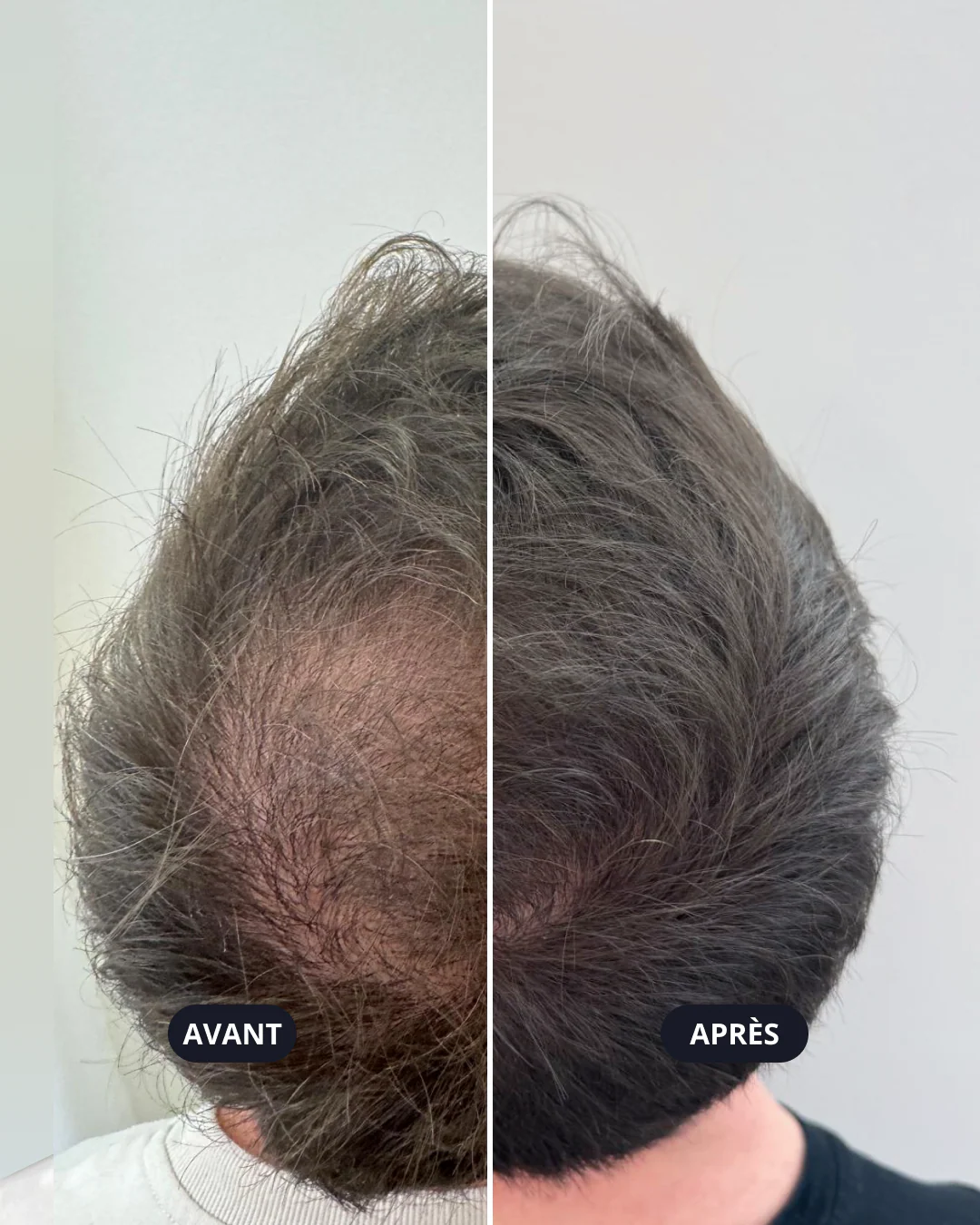 Avant après injection de PRP visage chez un homme à Paris montrant l’amélioration de la qualité de peau et la régénération cutanée après traitement par plasma riche en plaquettes.