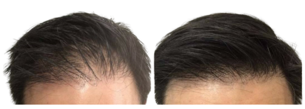 Avant après PRP capillaire chez un homme à Paris montrant une amélioration de la densité capillaire et un ralentissement de la calvitie après injections de plasma riche en plaquettes.