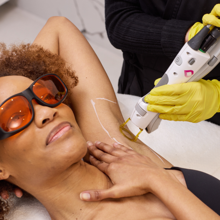 Traitement d’épilation laser des aisselles en cabinet médical à Paris, séance réalisée avec laser dermatologique haute précision.