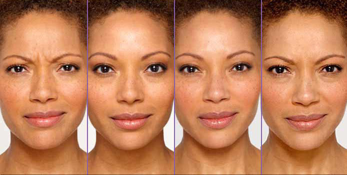 Avant après injection de Botox sur les rides du front chez une patiente à Paris