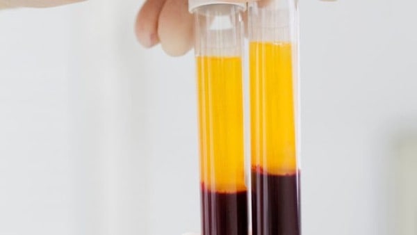 Deux tubes de PRP (plasma riche en plaquettes) après centrifugation dans un centre de médecine esthétique à Paris, préparation pour injection régénérative.