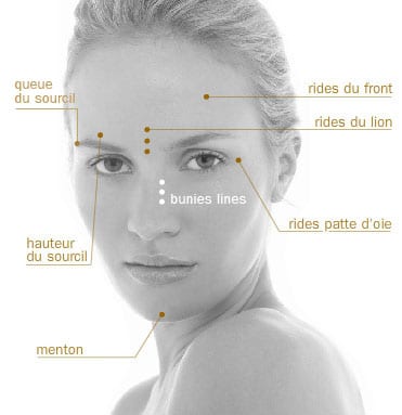 Schéma des principales zones d’injection du Botox sur le visage à Paris