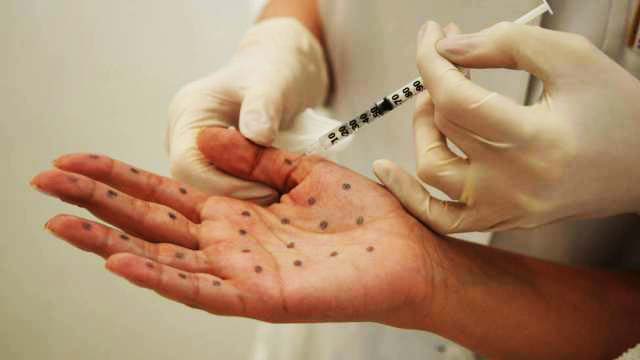 injection botox hyperhidrose rapide paris traitement transpiration