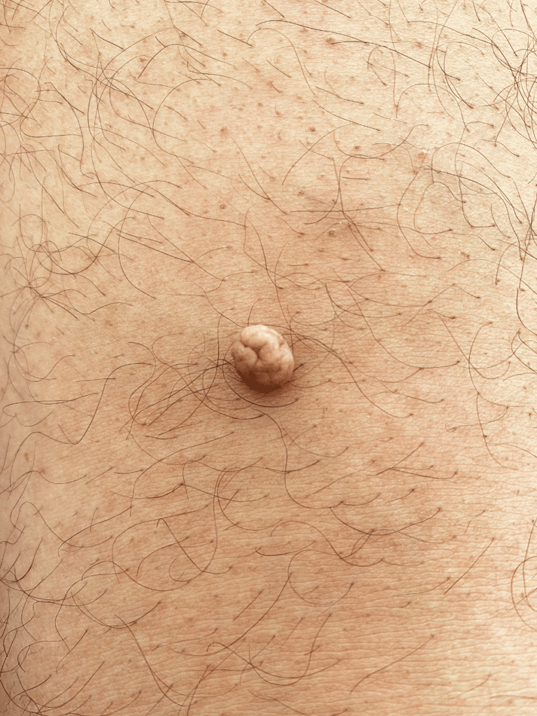 molluscum contagiosum traitement dermatologique paris centre du champ de mars