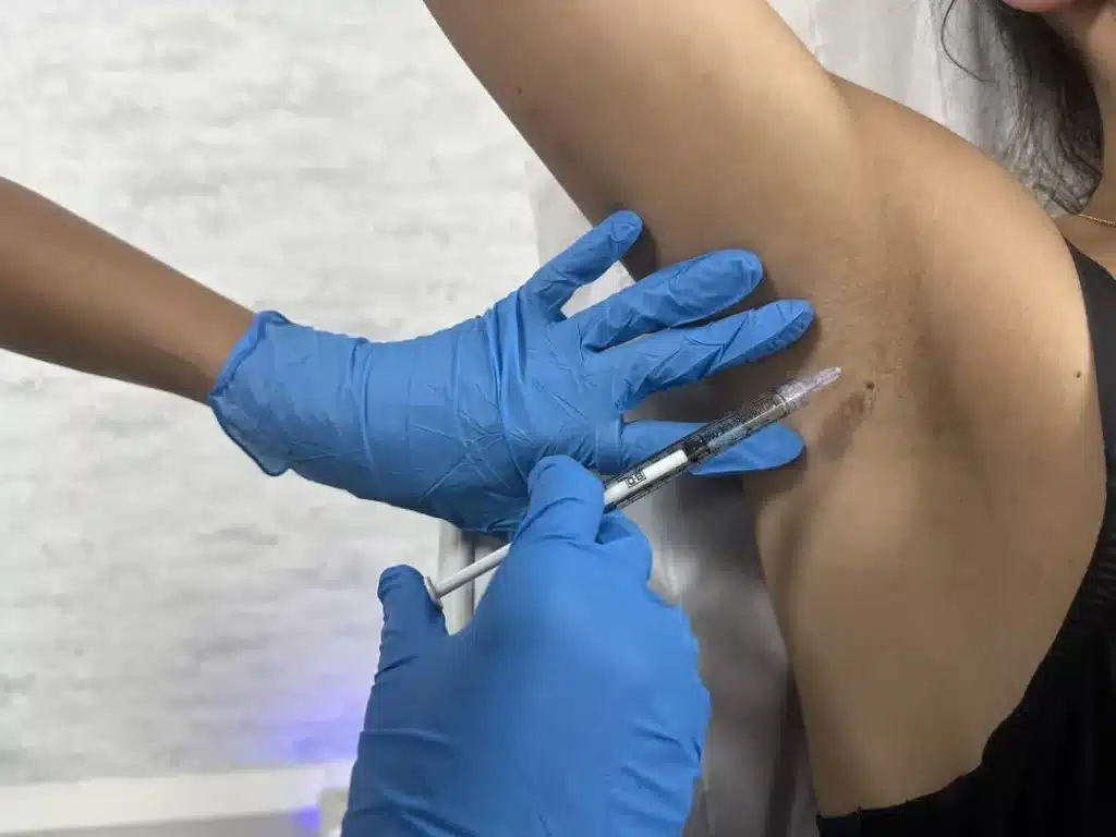 botox hyperhidrose aisselles reduction transpiration paris